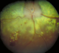 Akute Chorioretinitis