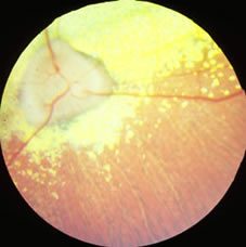 PRA mit dünnen Netzhautgefässen und hyperreflektivem Tapetum